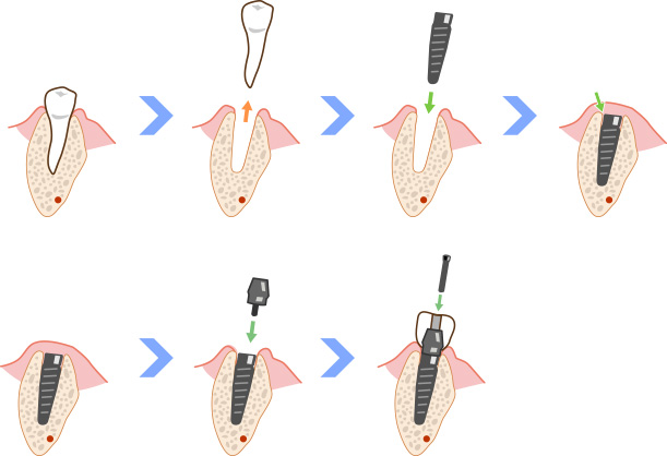 抜歯即時埋入
