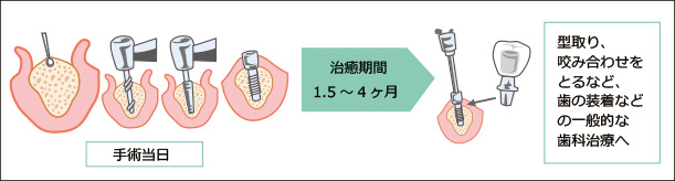 インプラント治療1回法