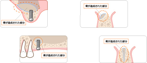 骨が足りない人へ