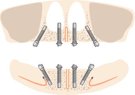 4本のインプラントで支える