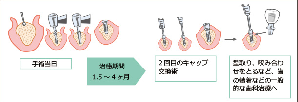 インプラント治療2回法