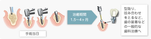 インプラント1回法