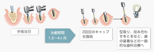 インプラント2回法