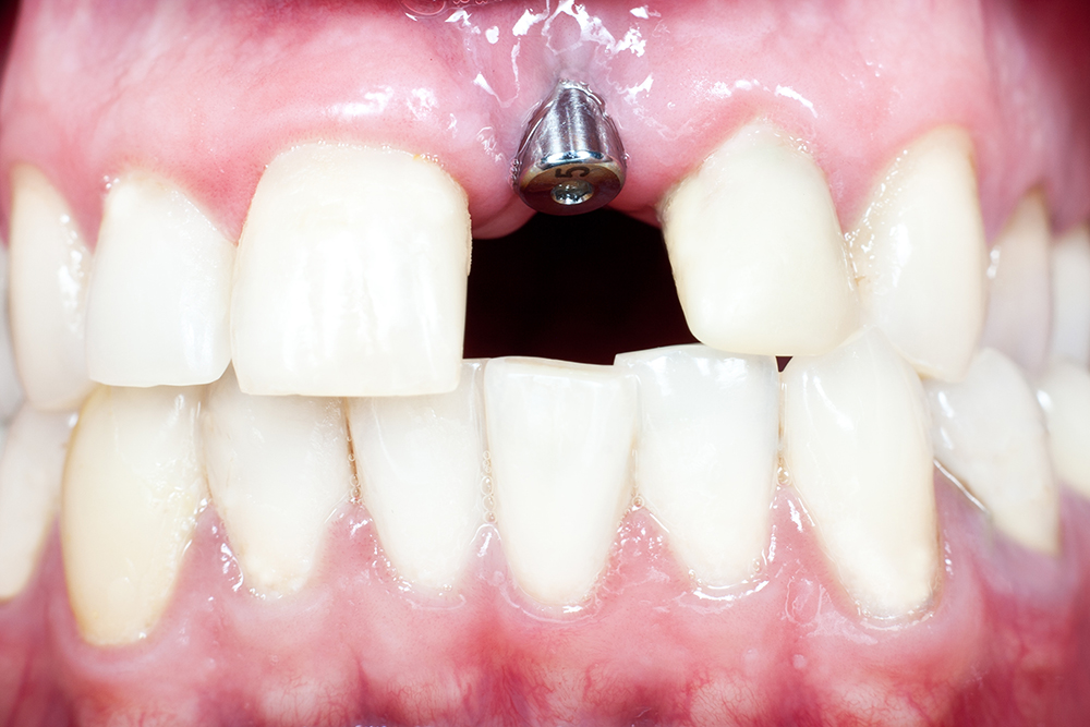 インプラントは、失った歯を歯根から回復できる唯一の装置です