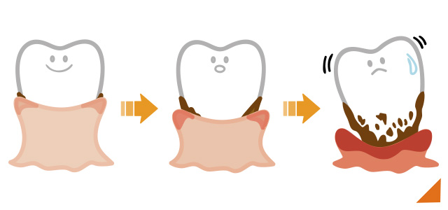 歯周病