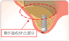 骨が造成された部分