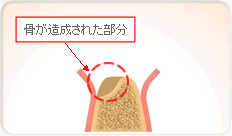 骨が造成された部分