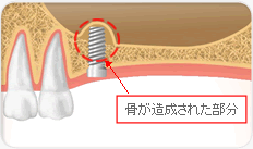 骨が造成された部分