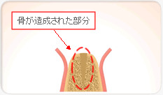 骨が造成された部分