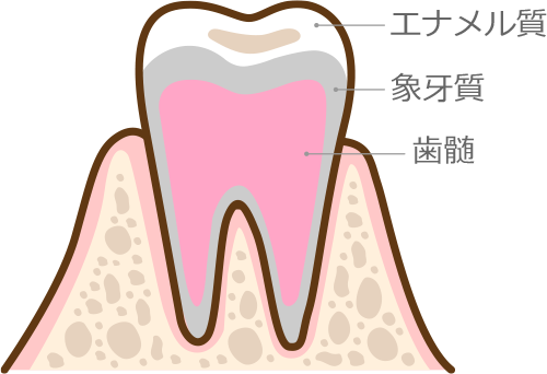 歯の一番表面のエナメル質部分が少し溶けた状態