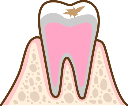 初期の虫歯の状態