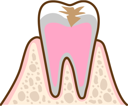 虫歯が象牙質にまで到達した状態