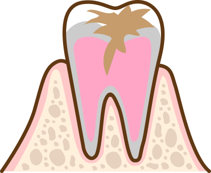 虫歯が奥の神経まで到達している状態
