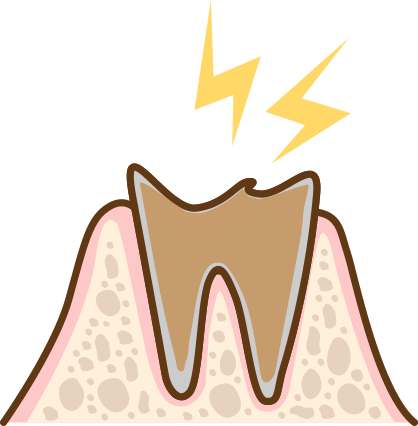 虫歯末期の状態