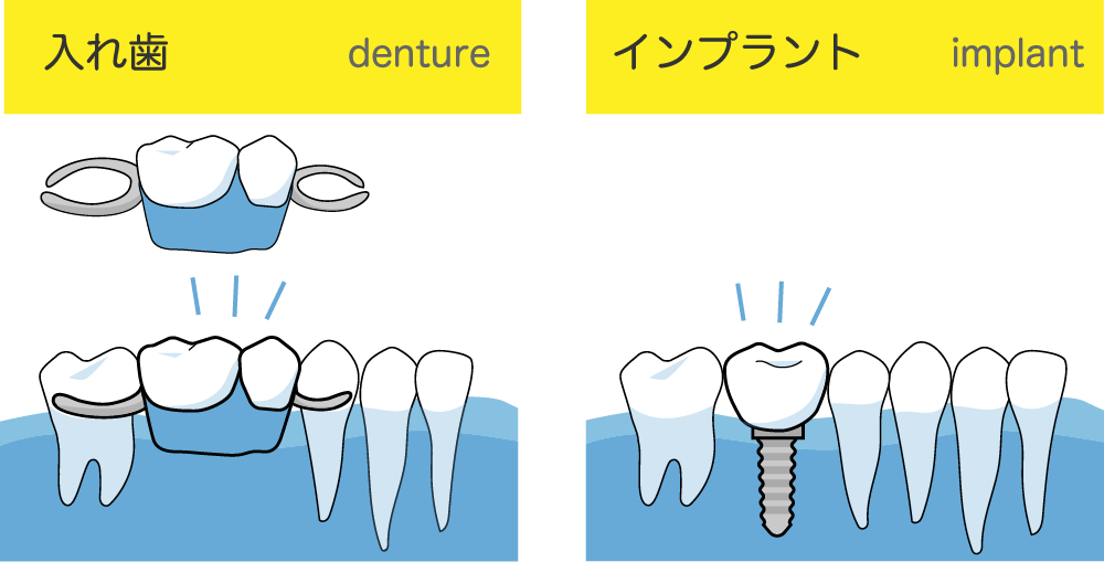 インプラントと入れ歯の違い