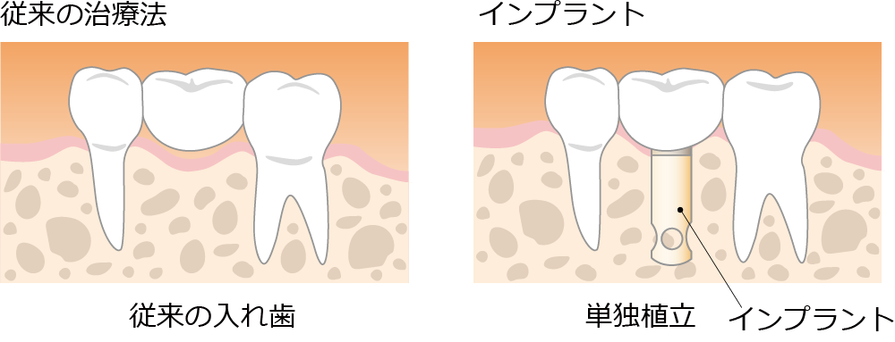 インプラントと入れ歯との比較