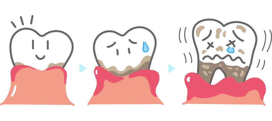 歯周病の症状