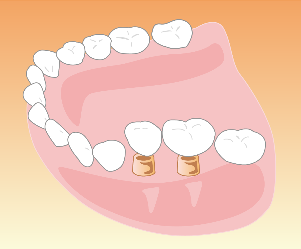 インプラントは失った歯を補う治療法