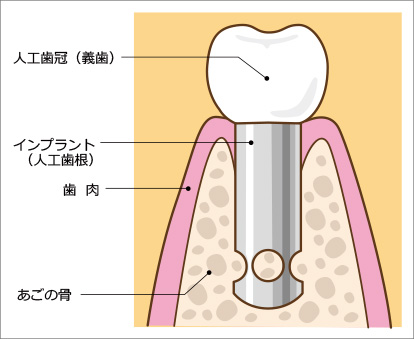 インプラントの構造