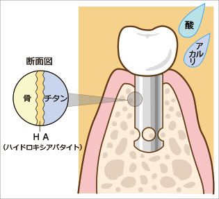 インプラントの断面図