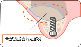 骨が造成された部分