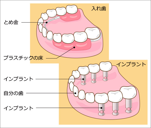 インプラントと入れ歯の違い