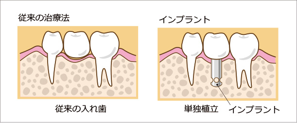 従来の治療とインプラント治療