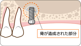 骨が造成された部分