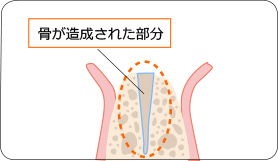 骨が造成された部分