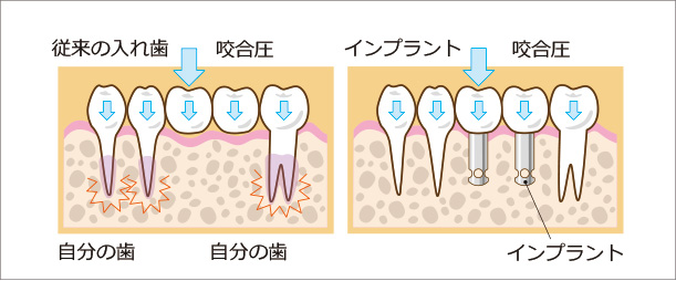 咬合圧による歯への負担