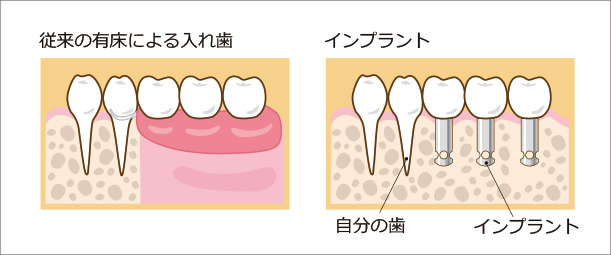 従来の有床による入れ歯とインプラント