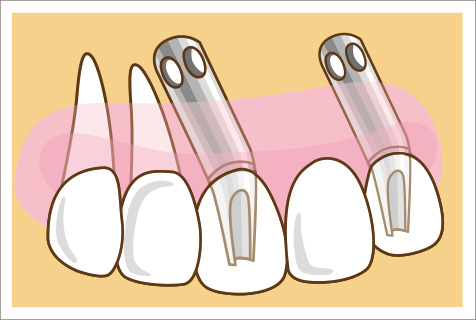 インプラントの拡大図