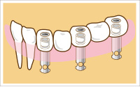 3本のインプラント