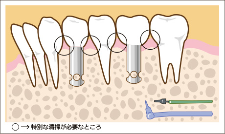 インプラントの清掃箇所