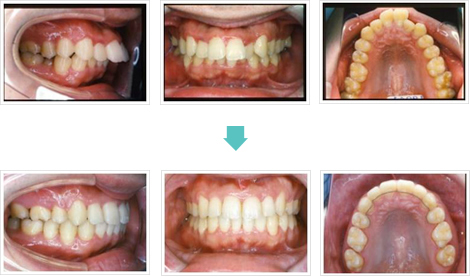 出っ歯治療前後