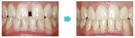 すきっ歯治療前後