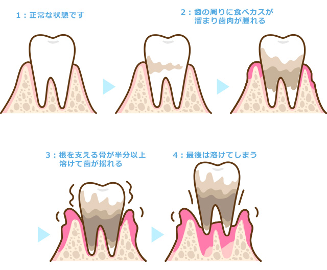 歯周病進行 ① 正常な状態です。② 歯の周りに食べカスが溜まり歯肉が腫れる。③ 根を支える骨が半分以上溶けて歯が揺れる。④ 最後は溶けてしまう。