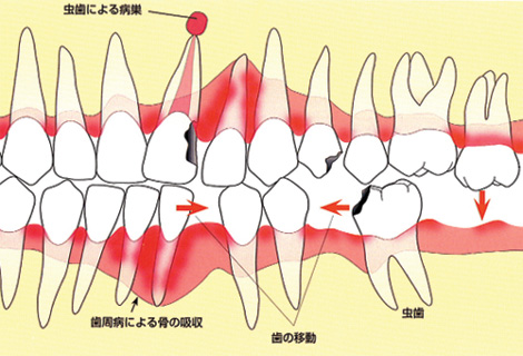 相手方・隣の歯