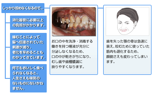 奥歯を失うと起こる障害1