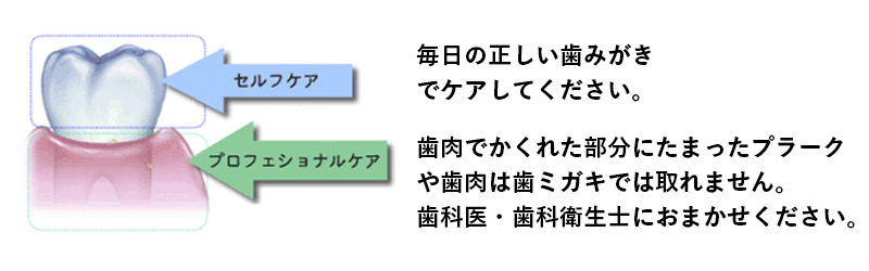 セルフケア:毎日の正しい歯みがきでケアしてください。プロフェッショナルケア:歯肉でかくれた部分にたまったプラークや歯肉は歯ミガキでは取れません。歯科医・歯科衛生士におまかせください。