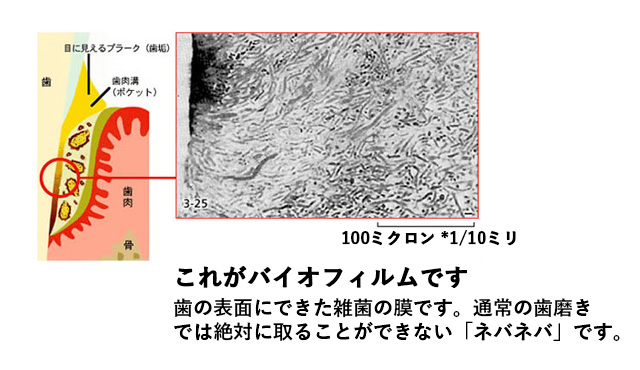 これがバイオフィルムです。歯の表面にできた雑菌の膜です。通常の歯磨きでは絶対に取ることができない「ネバネバ」です。