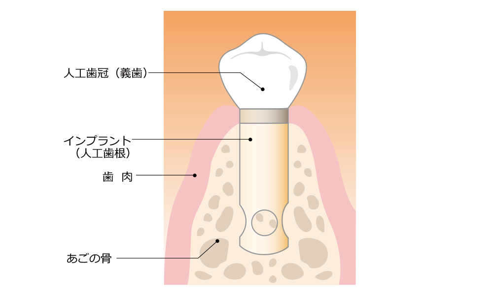 インプラントとは