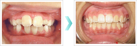 子供の矯正の症例