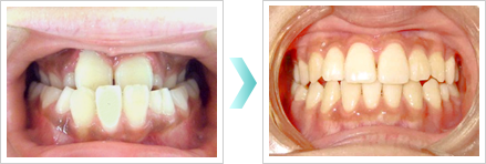 子供の矯正の症例