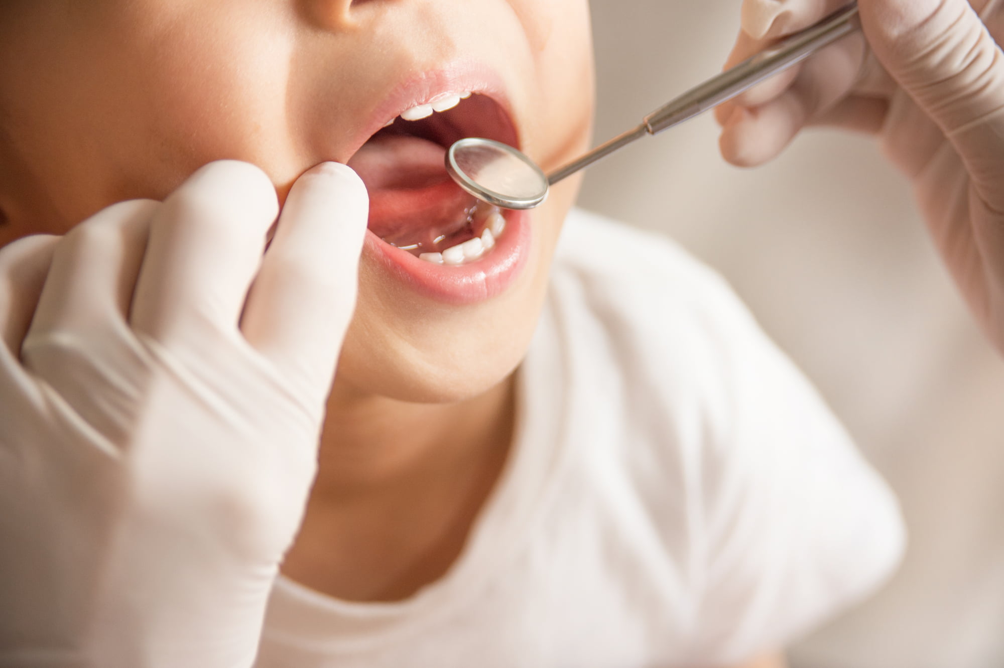 歯石の有無を歯科医にチェックしてもらっている子ども